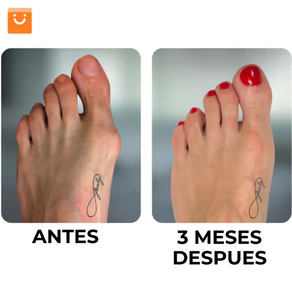 Corrector De Juanetes JuanetFLex®